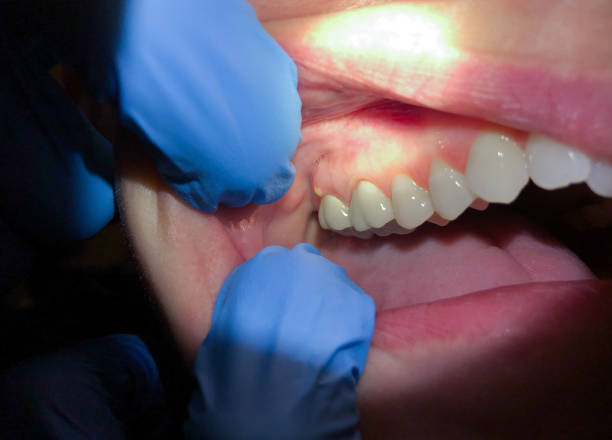 Best Emergency Dental Extractions in Oak Hills, PA